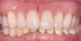 Family Dental Care - Crowns (Caps) - Dental Implants - Dentures & Partial Dentures - Porcelain Crowns (Caps) After