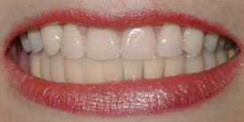Family Dental Care - Crowns (Caps) - Dental Implants - Dentures & Partial Dentures - Porcelain Crowns (Caps) After