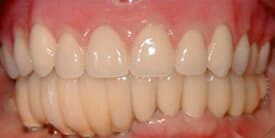 Family Dental Care - Crowns (Caps) - Dental Implants - Dentures & Partial Dentures - Porcelain Crowns (Caps) Before