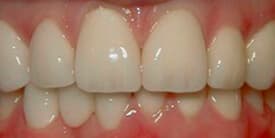 Family Dental Care - Porcelain Crowns (Caps) After