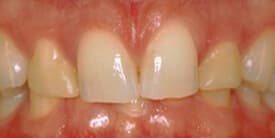 Family Dental Care - Porcelain Crowns (Caps) Before