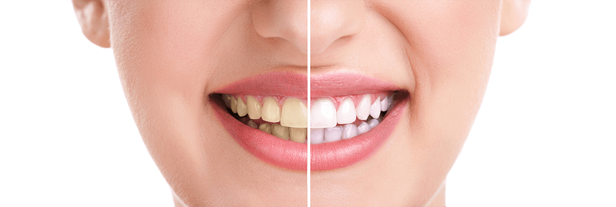 Teeth Whitening in Beaverton, Oregon